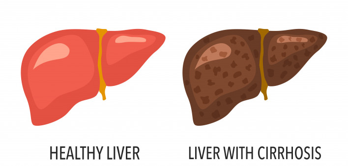cirrhosis