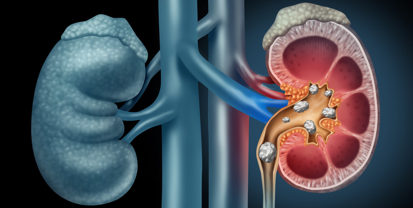 Findings Show That Kidney Stones Grow and Dissolve in the Body Real